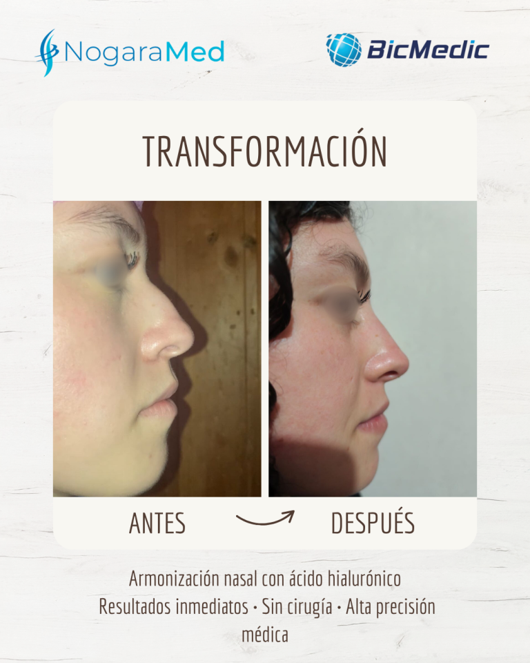 antesdesspues